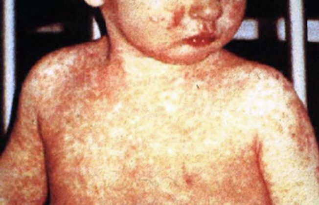 Measles Exposure Warning Issued for Strong Memorial ER