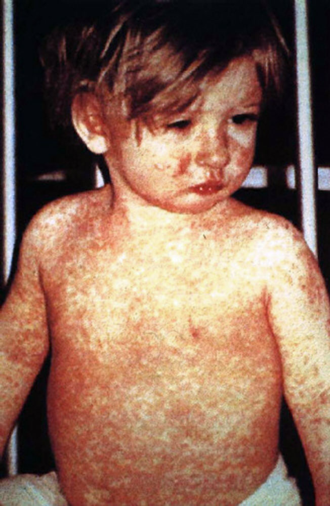 Measles Exposure Warning Issued for Strong Memorial ER