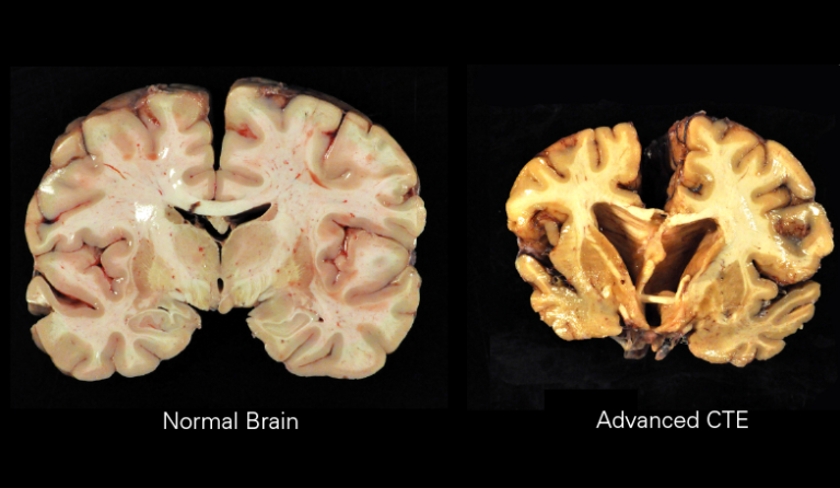 When Dementia Patients Grow Lucid Near the End